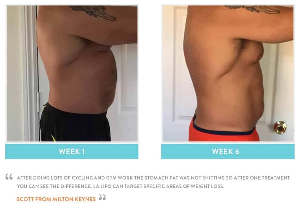 Before & After Stomach Fat Shepherd's Bush
