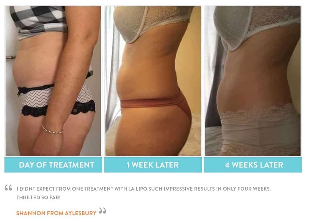 before, Cryolipolysis Shepherd's Bush