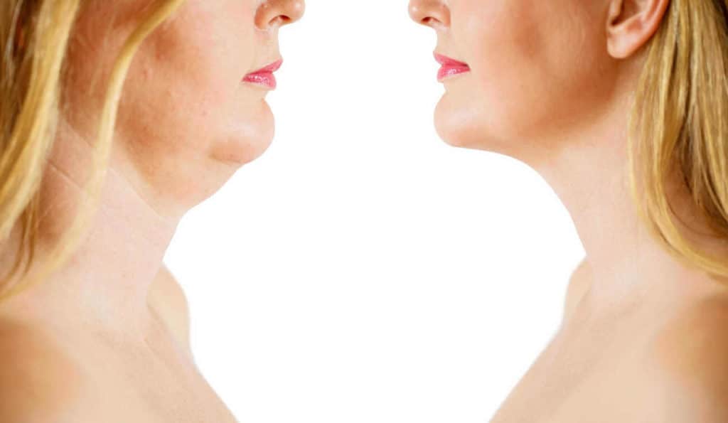 Double Chin treatment Shepherd's Bush before and after results