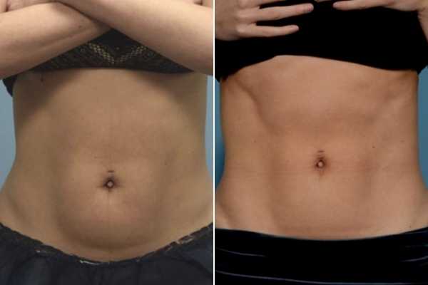 body sculpting FAQs Shepherd's Bush