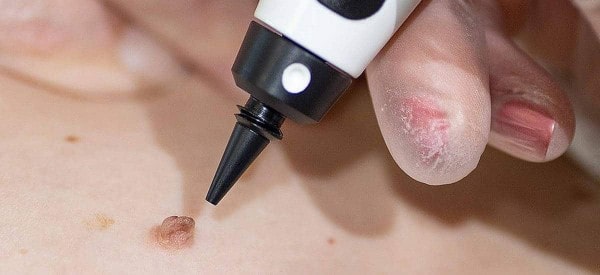 After Skin Tag Removal Shepherd's Bush
