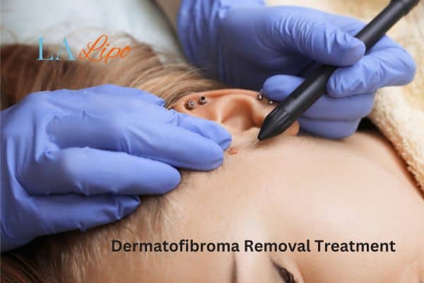 Dermatofibroma Removal Treatment Shepherd's Bush