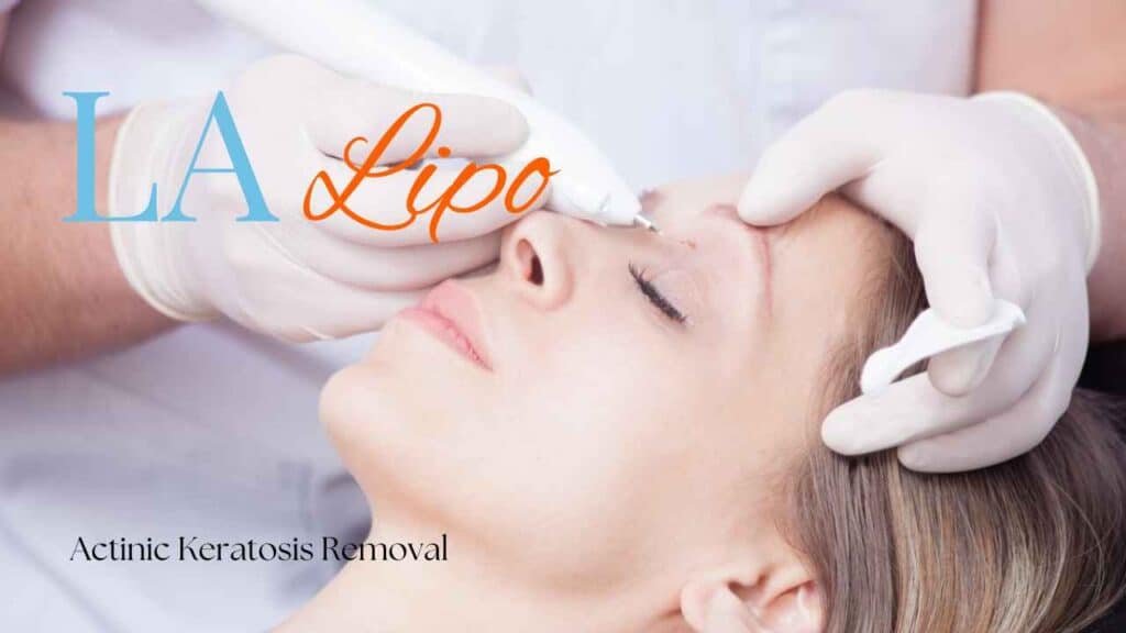 actinic keratosis removal Shepherd's Bush