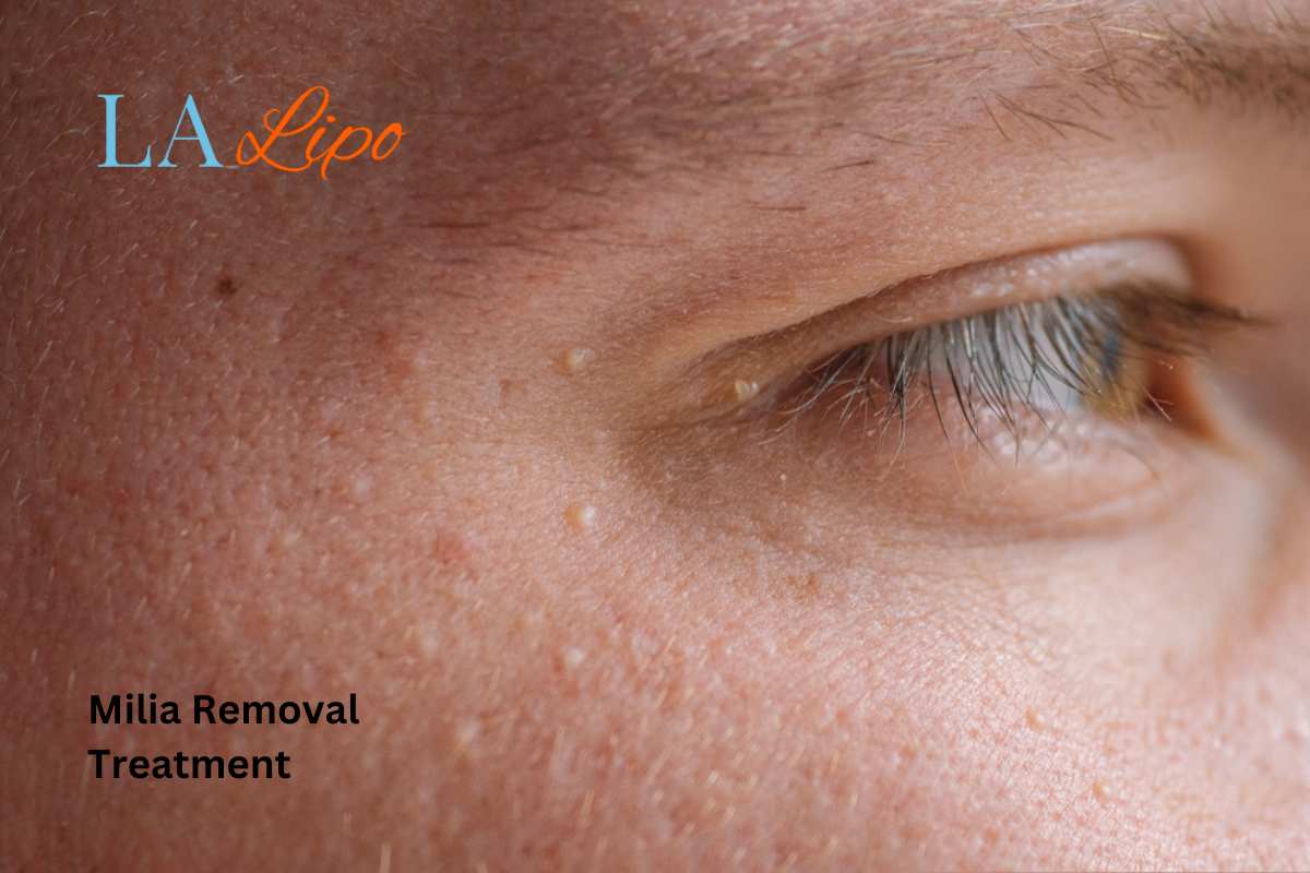Cryopen Milia Removal: Is It the Easiest and Safest Option Shepherd's Bush?