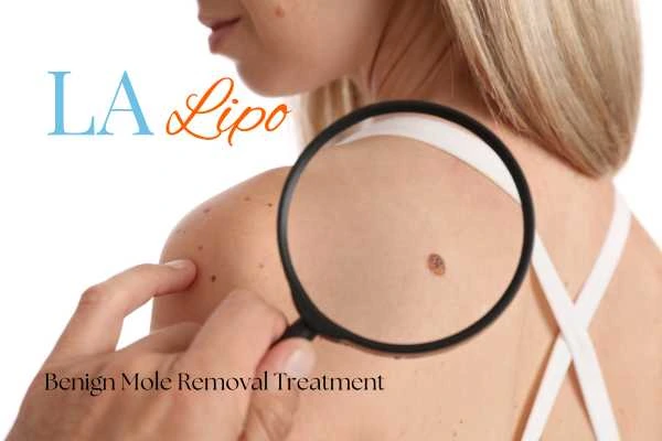 Woman having her inspection of blemish before mole removal Shepherd's Bush