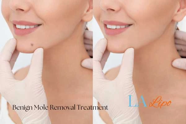 woman's before and after mole removal Shepherd's Bush results