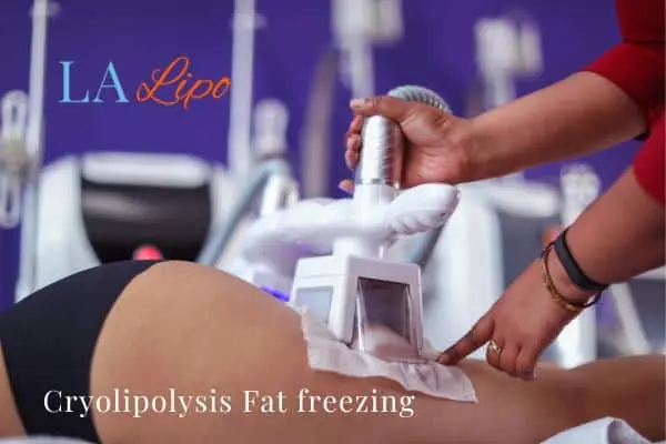 women getting fat freezing Shepherd's Bush