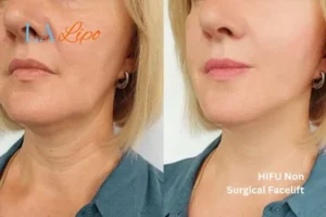 hi-fu for wrinkles Shepherd's Bush before and after results