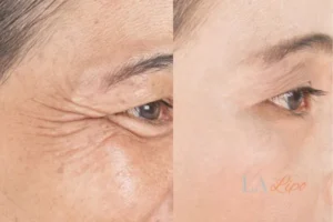 Before and after results of woman - HI-fu wrinkles reduction treatment Shepherd's Bush