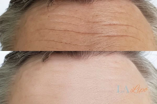 results of HIFU Shepherd's Bush on mans forehead to help reduce lines and wrinkles