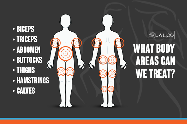 Graphic to show areas you can have LA-EMS Body Sculpting Shepherd's Bush treatment.