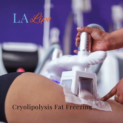 fat freezing - Cryolipolysis Shepherd's Bush