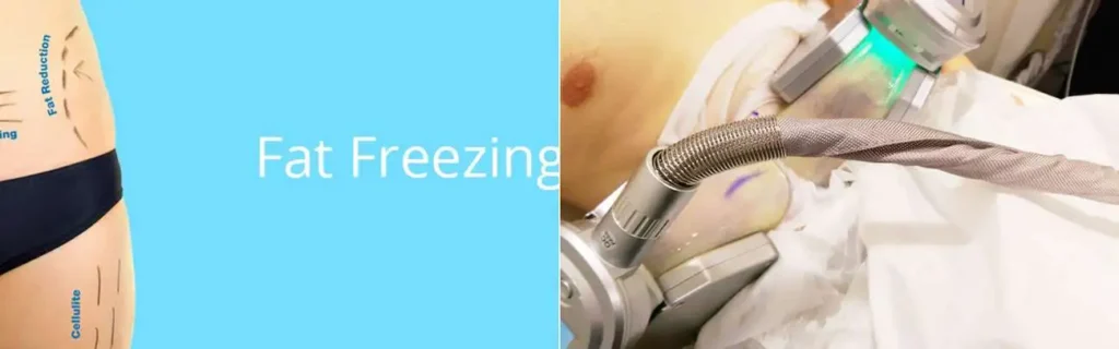 Fat freezing Shepherd's Bush on multiple areas of the body