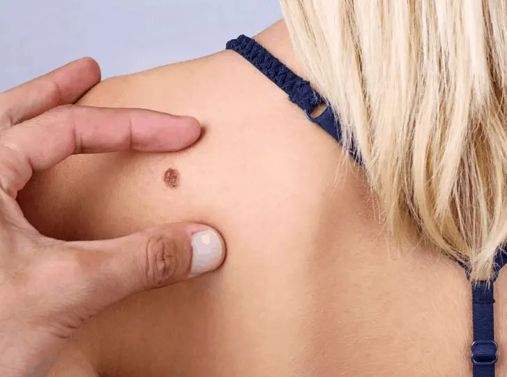 woman having mole removal Shepherd's Bush consultation before treatment.
