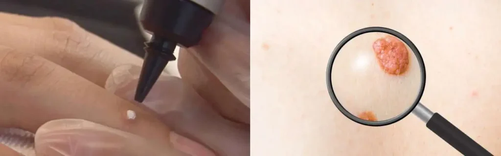 Cryopen for mole removal Shepherd's Bush - speak to our team today!