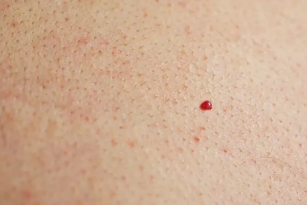 close up of a cherry angioma Shepherd's Bush
