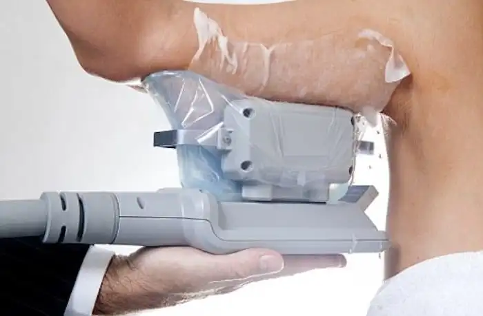Picture of fat freezing Shepherd's Bush on the upper arms.