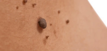 image of a skin tag Shepherd's Bush