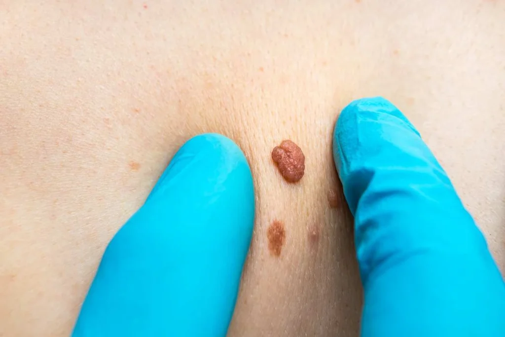 Consultant examining a skin tag Shepherd's Bush