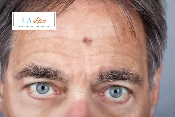 Solar Lentigo Removal Shepherd's Bush image of man with mark on his forehead