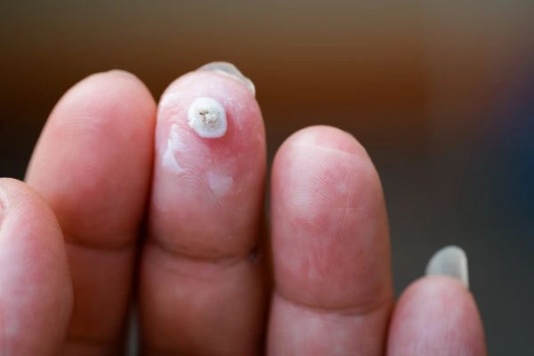 wart on person finger - cryotherapy to treat from LA LIPO Shepherd's Bush