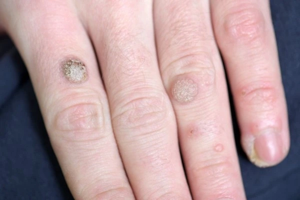 photo of warts on person hand - see wart removal Shepherd's Bush from LA LIPO