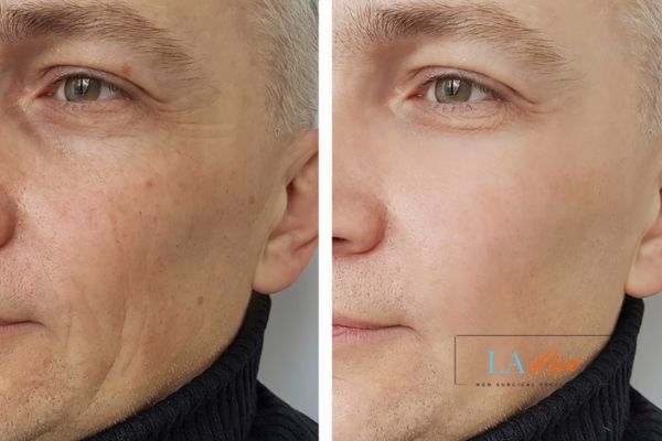 See the amazing results of Morpheus8 Treatment Shepherd's Bush!