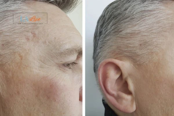 Mens Before & After Morpheus 8 Results Shepherd's Bush