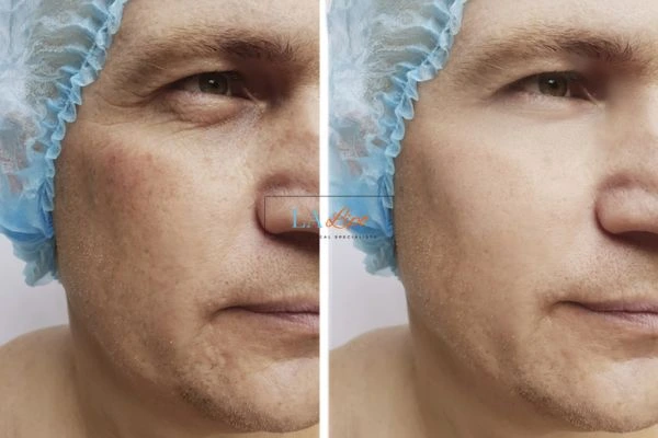 Before and after Morpheus 8 Results Shepherd's Bush