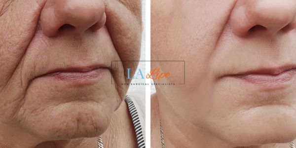Older lady deeper wrinkle reduction - LA LIPO Morpheus 8 Results Shepherd's Bush