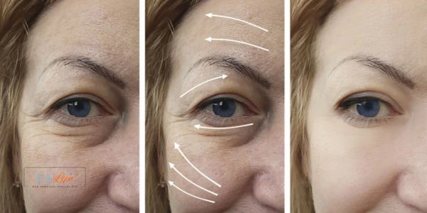 Amazing eye lift Morpheus 8 results Shepherd's Bush