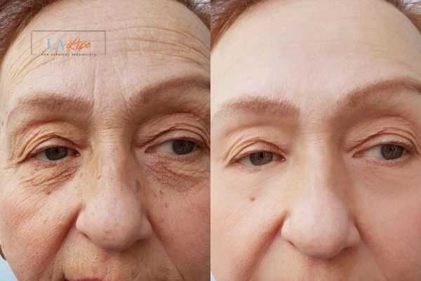 The powerful benefits of Morpheus8 Treatment Shepherd's Bush - Call Our team today!