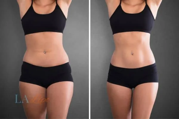 before and after results of non-surgical treatment to help a woman's body image and mental health Shepherd's Bush