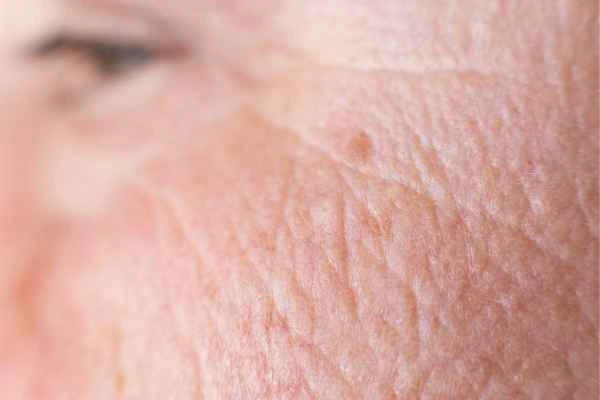 close up picture of a woman's face showing an age spot Shepherd's Bush