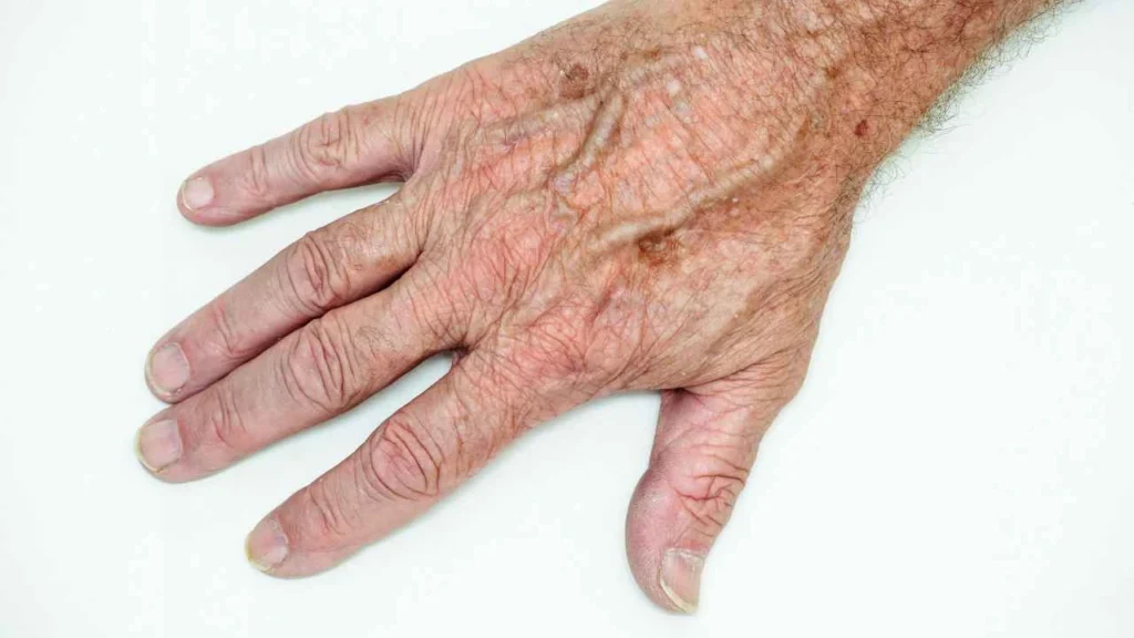 Male hand showing age spot Shepherd's Bush