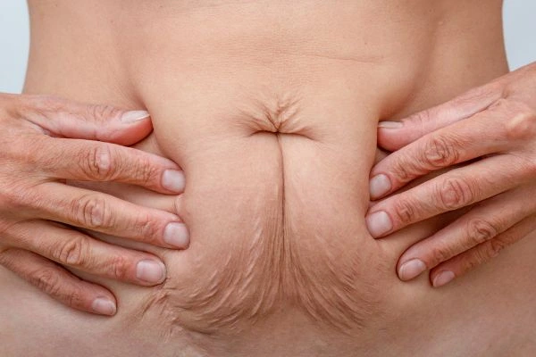 Image of a woman's stomach with loose skin - example of skin tightening Shepherd's Bush options