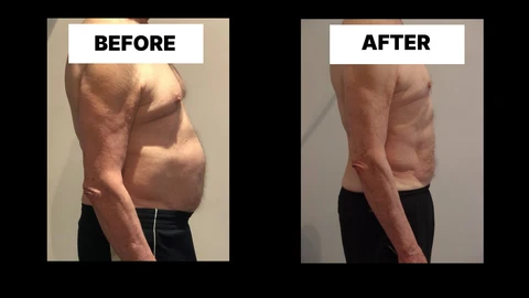 What Symptoms Can Diastasis Recti Cause in Men? Weak Core, Back Pain and Poor Posture Shepherd's Bush